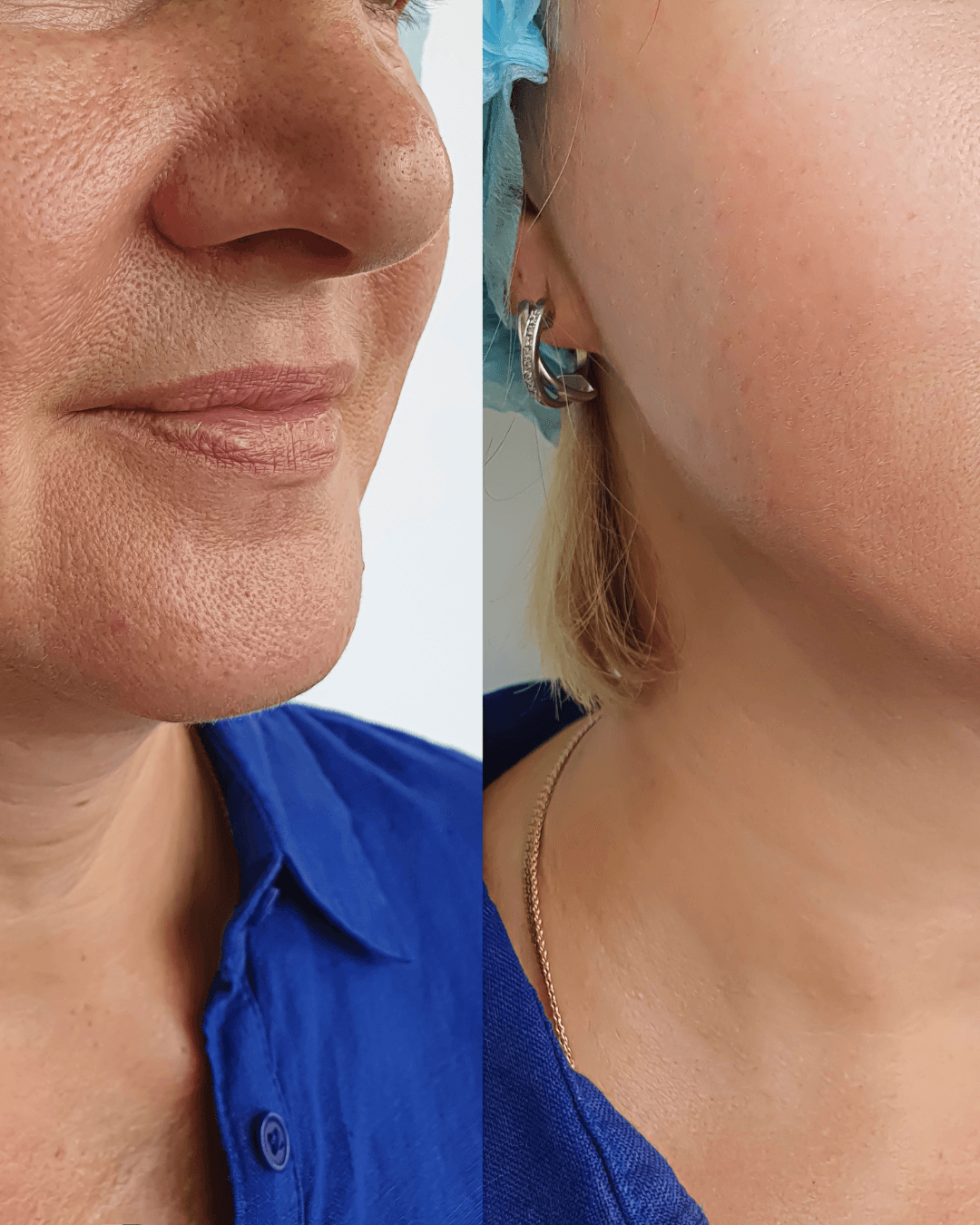 Fältchen → Straffere Haut — Aquafacial Heilbronn C&C Beauty