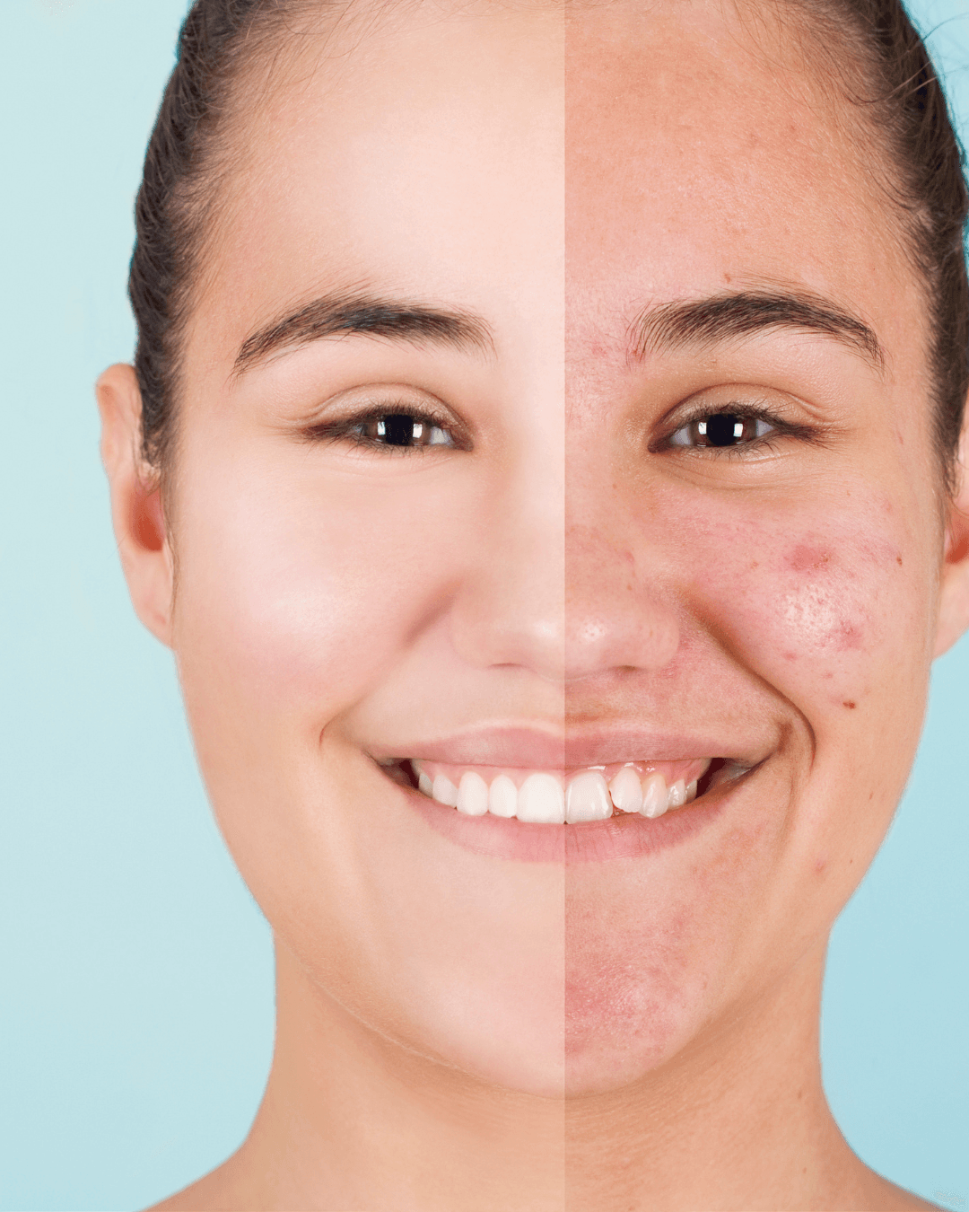 Unreine Haut → Klares Hautbild — Aquafacial Heilbronn C&C Beauty