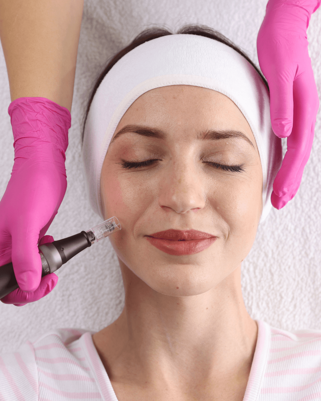 Microneedling Behandlung C&C Beauty Heilbronn — professionell & sanft